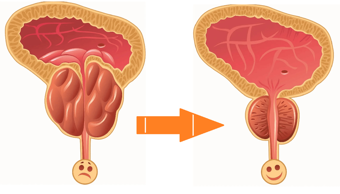 Uromexil Forte AKCIJA NA Prostatu s prostatitisom i adenomom
