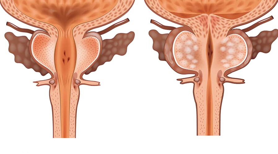 usporedba zdravog i upaljenog adenoma