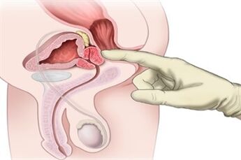 Masaža prostate za liječenje kroničnog prostatitisa