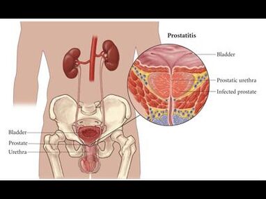 Prostatitis – upala prostate