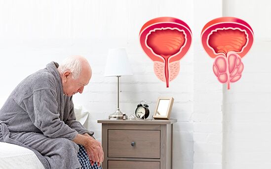 prostatitis kod muškarca